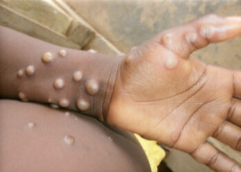 Ghana Confirms 5 Monkeypox Cases In 3 Regions